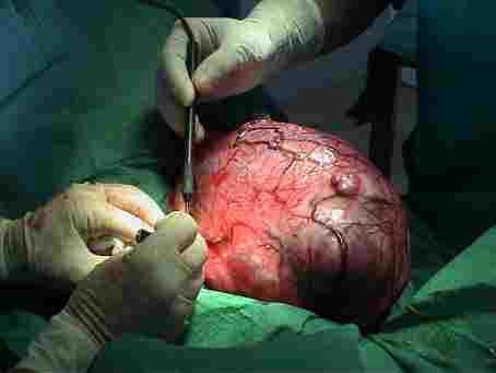 Vis&atilde;o da Neoplasia Renal